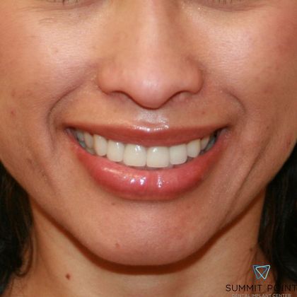 Veneers Case 4 - After