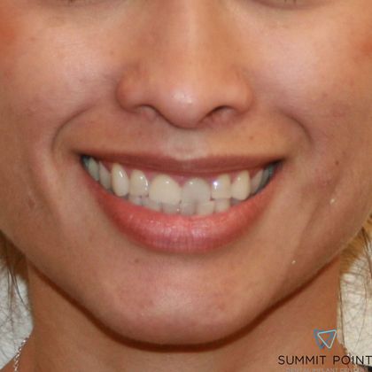 Veneers Case 4 - Before