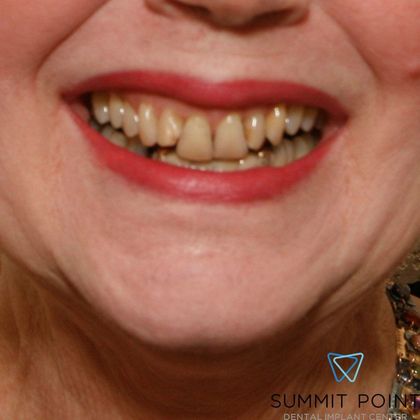 Dental Crowns Case 2 - Before