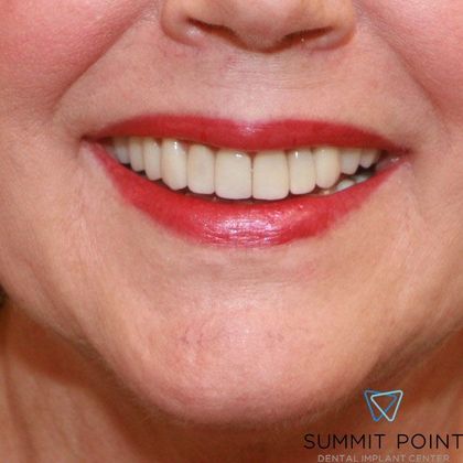 Dental Crowns Case 2 - After