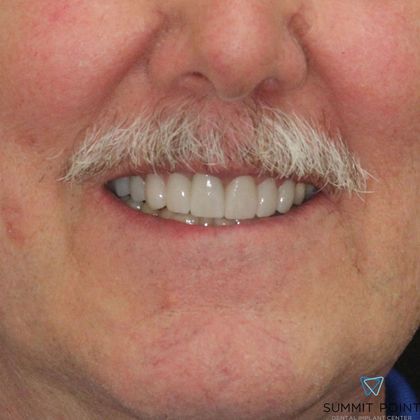 Dental Crowns Case 3 - After