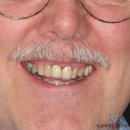 Dental Crowns Case 3 - Before