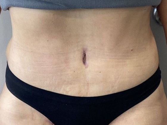 Tummy Tuck: Case 21 Tummy Tuck with Liposuction, Cheshire, CT - After