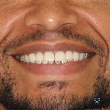 Dental Crowns Case 4 - After