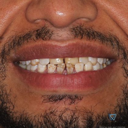 Dental Crowns Case 4 - Before