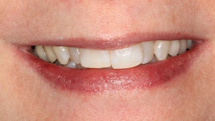 Invisalign Case 2 - Before