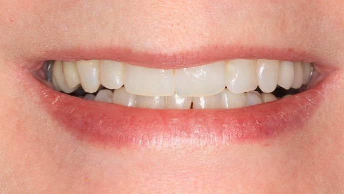 Invisalign Case 2 - After