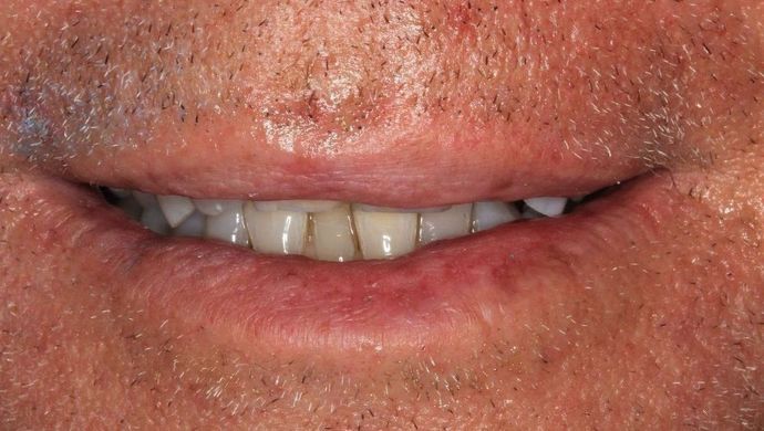 Invisalign Case 3 - Before