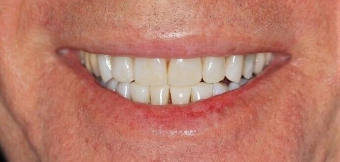 Invisalign Case 3 - After