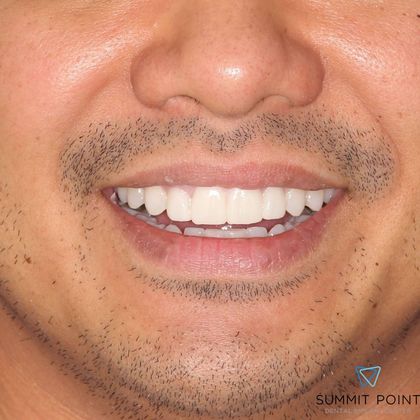 Veneers Case 5 - After