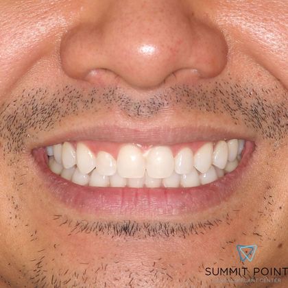 Veneers Case 5 - Before