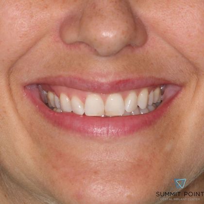 Veneers Case 6 - Before