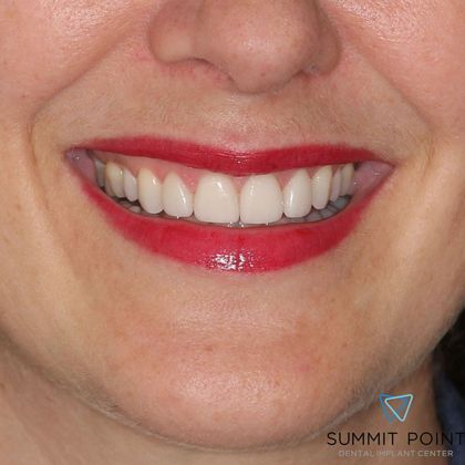 Veneers Case 6 - After