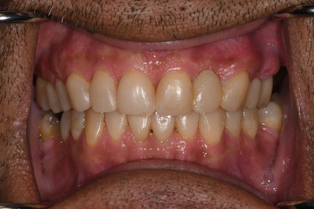 Full Mouth Reconstruction Case 3 - Port Lavaca, TX - After