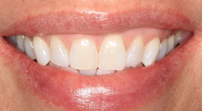Invisalign Case 4 - Before