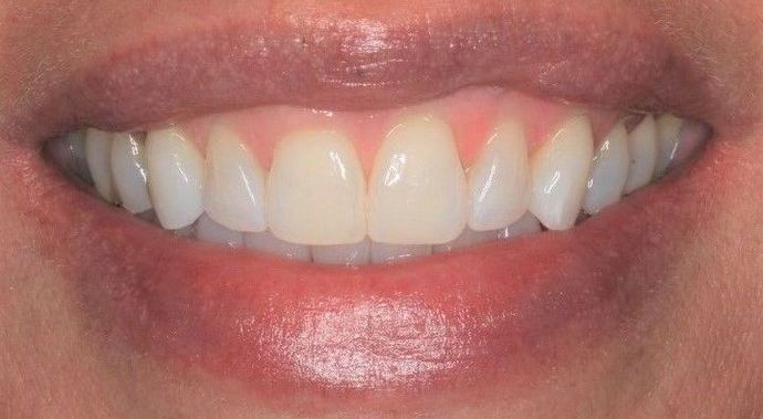 Invisalign Case 4 - After