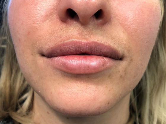 Cosmetic Injectables & Fillers*: Case 40 Lip Filler - After