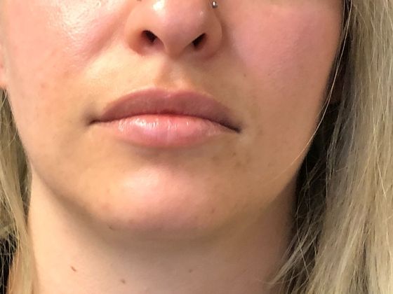 Cosmetic Injectables & Fillers*: Case 40 Lip Filler - Before