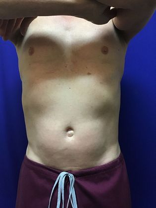 Cooltone Muscle Stimulation: Case 2 - After
