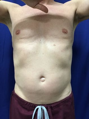 Cooltone Muscle Stimulation: Case 2 - Before