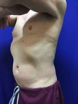Cooltone Muscle Stimulation: Case 2 - After