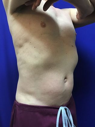 Cooltone Muscle Stimulation: Case 2 - Before