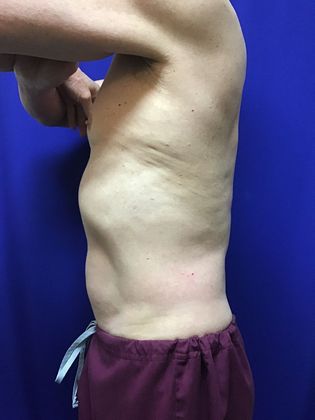 Cooltone Muscle Stimulation: Case 2 - After