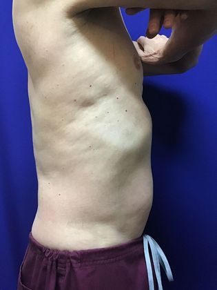 Cooltone Muscle Stimulation: Case 2 - After