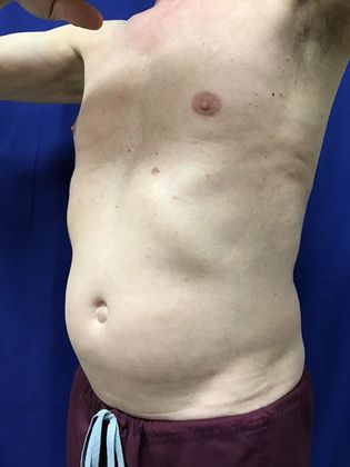 Cooltone Muscle Stimulation: Case 2 - Before
