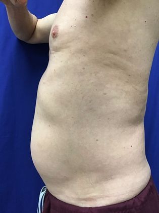 Cooltone Muscle Stimulation: Case 2 - Before