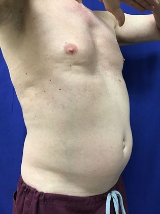 Cooltone Muscle Stimulation: Case 2 - After