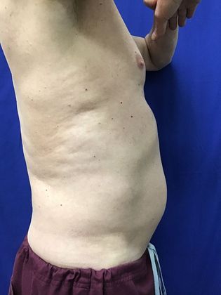 Cooltone Muscle Stimulation: Case 2 - Before