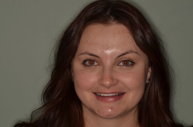 Composite Bonding: Case 7 - After