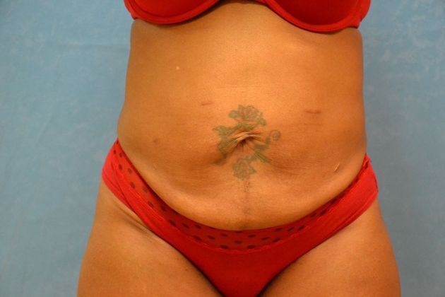 Tummy Tuck Case 1807- Toledo, OH - Before