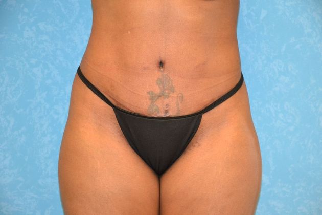 Tummy Tuck Case 1807- Toledo, OH - After