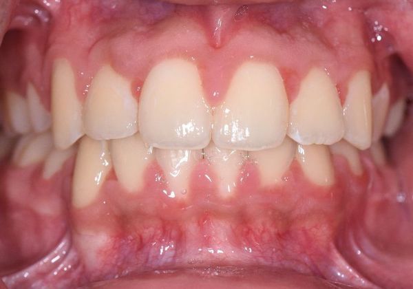 Braces Case 2 - Victoria, TX - After