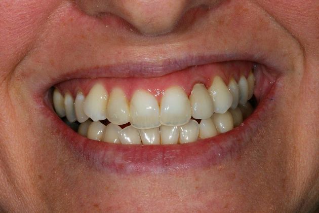 Before and After Gallery Case 3 Crown - After