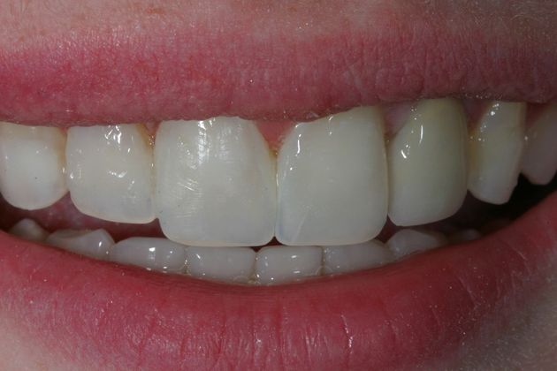 Before and After Gallery Case 4 Bonding - After