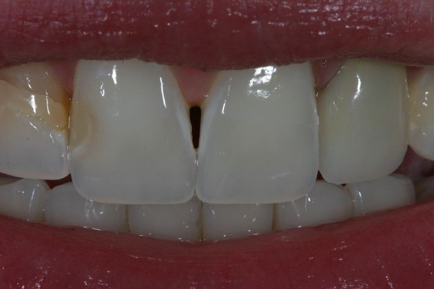 Before and After Gallery Case 4 Bonding - Before