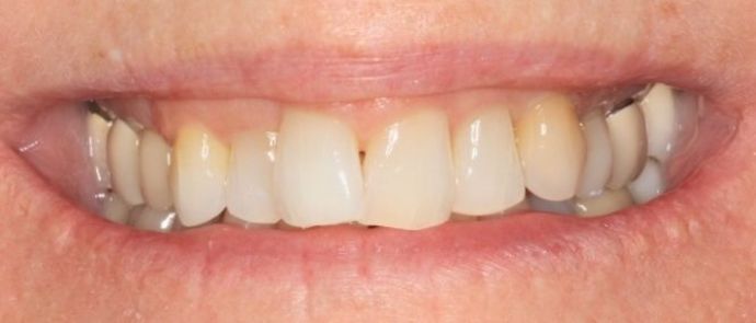 Invisalign Case 5 - Before