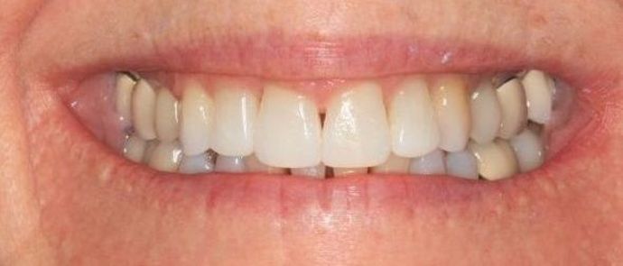 Invisalign Case 5 - After
