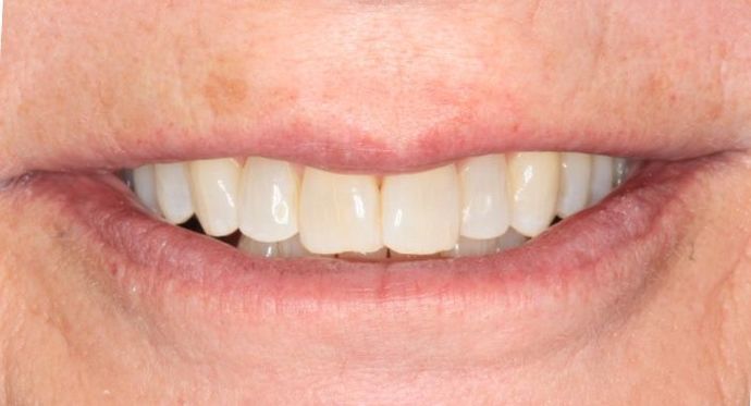 Invisalign: Case 8 - Before