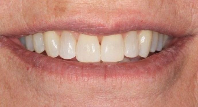 Invisalign: Case 8 - After
