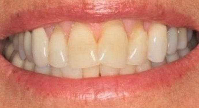 Invisalign Case 10 - Before