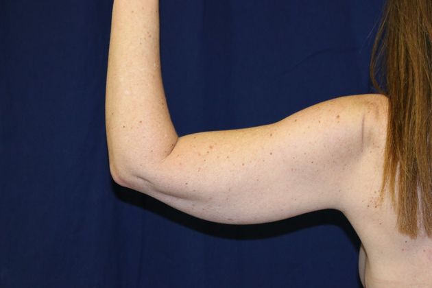 Arm Lift*/Arm Sculpting: Case 10 - Before