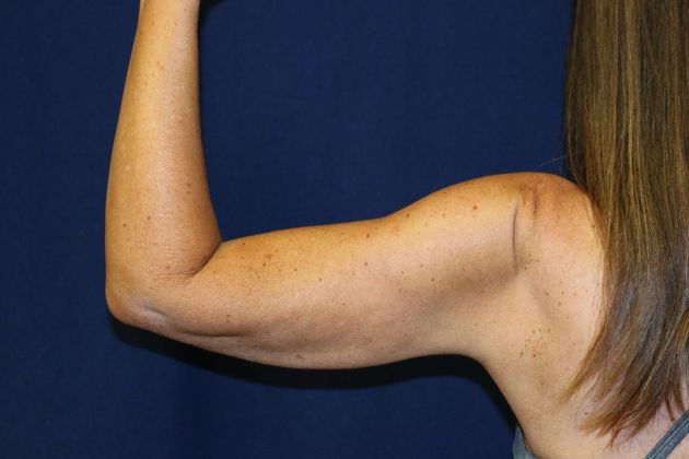 Arm Lift*/Arm Sculpting: Case 10 - After