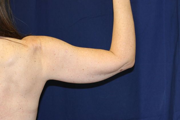 Arm Lift*/Arm Sculpting: Case 10 - Before