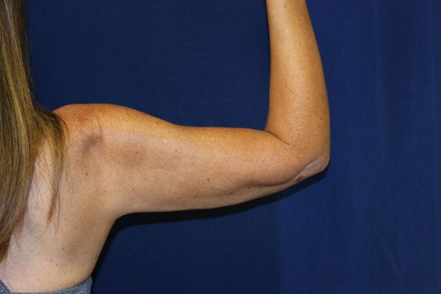 Arm Lift*/Arm Sculpting: Case 10 - After