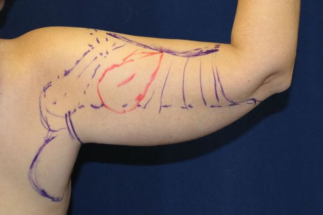 Arm Lift*/Arm Sculpting: Case 11 - Before