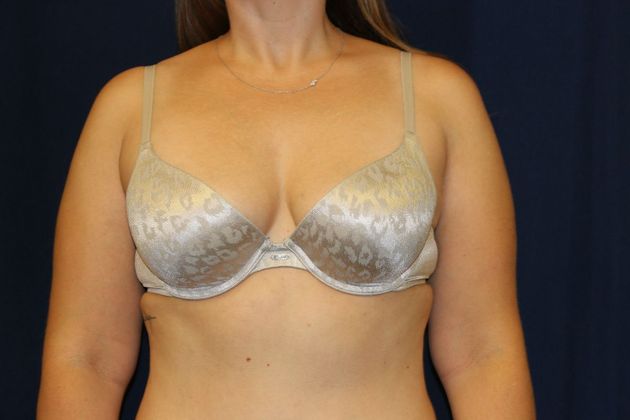 Arm Lift*/Arm Sculpting: Case 11 - Before